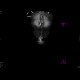 Caput medusae, porto-venous shunts, splenomegaly: CT - Computed tomography